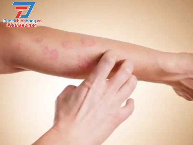 Cách trị ngứa bông thủy tinh tại nhà Cách trị ngứa bông thủy tinh tại nhà